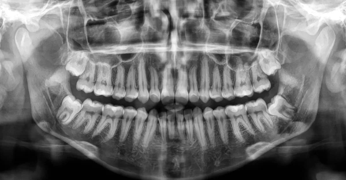 Czy ósemki rosną na górze? Prawda o zębach mądrości w jamie ustnej
